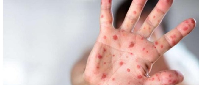 Armenian medics detect imported case of measles